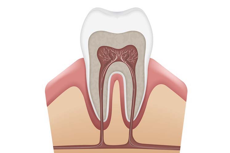 wortelkanaalbehandeling